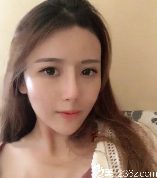福州名韓鼻綜合整形1個月恢復(fù)照