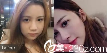 福州名韓陳聲瑾鼻綜合案例