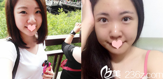 廣州曙光整形醫(yī)院王娟雙眼皮對比圖
