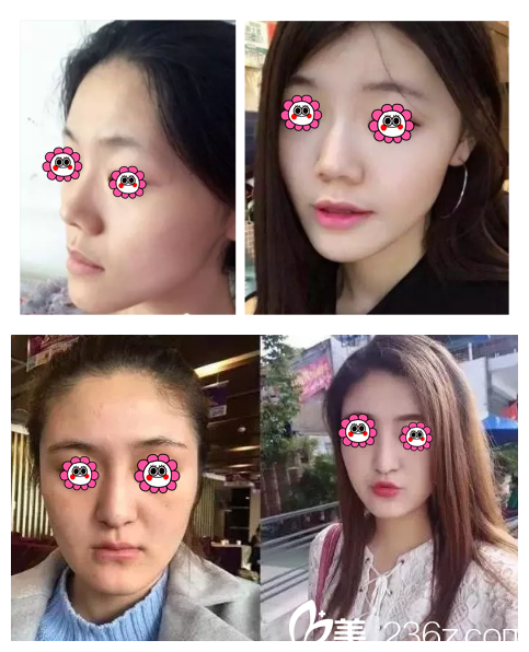 王培院長做自體脂肪填充面部案例 王培院長做自體脂肪填充面部案例