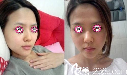 術(shù)前塌鼻和面部凹陷的我 術(shù)前塌鼻和面部凹陷的我