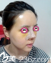 術(shù)后5天鼻子和面部慢慢恢復(fù)中 術(shù)后5天鼻子和面部慢慢恢復(fù)中