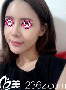 做完隆鼻和自體脂肪填充10天后的樣子 做完隆鼻和自體脂肪填充10天后的樣子