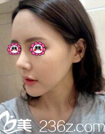 術(shù)后20天鼻子和面部正在恢復(fù)中 術(shù)后20天鼻子和面部正在恢復(fù)中