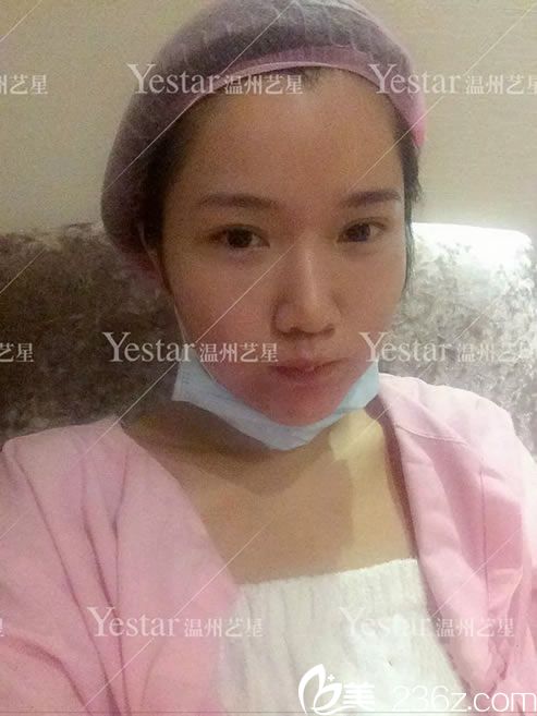 做鼻綜合整形手術(shù)前照片 做鼻綜合整形手術(shù)前照片