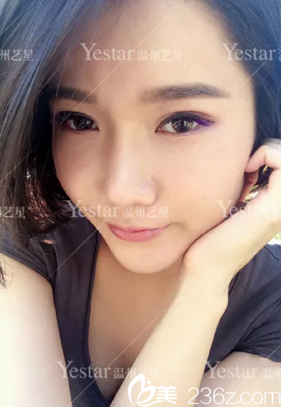 綜合隆鼻手術(shù)7天恢復照 綜合隆鼻手術(shù)7天恢復照