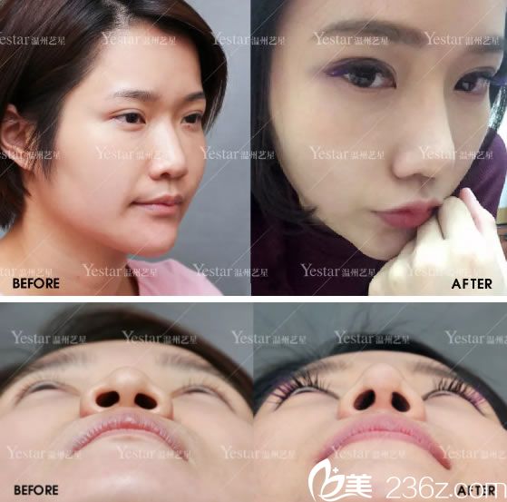 藝興綜合隆鼻手術(shù)前后<span style= 藝興綜合隆鼻手術(shù)前后<span style=