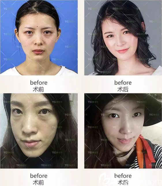 杭州時光自體脂肪填充蘋果肌案例