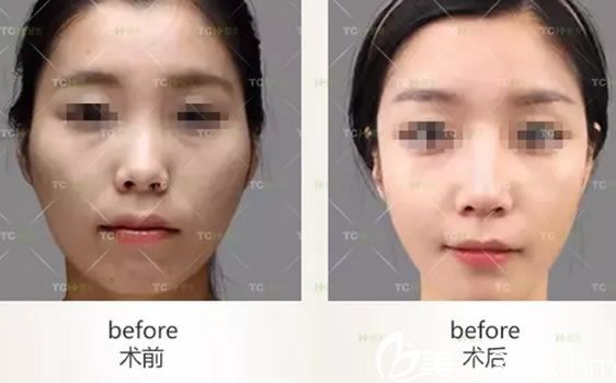 杭州時光顴骨降低整形案例