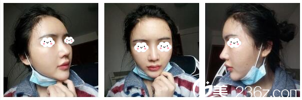 李波主任為我做完隆鼻9天了