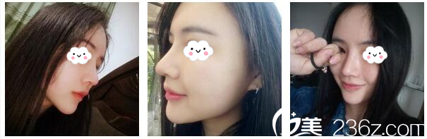 隆鼻術(shù)后20天恢復(fù)效果圖