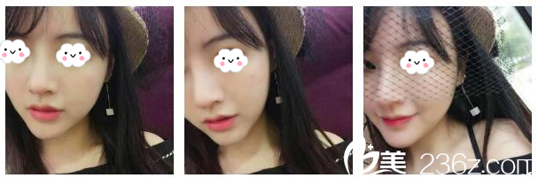 隆鼻術(shù)后20天自拍