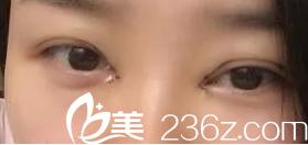 術(shù)后第三天照片