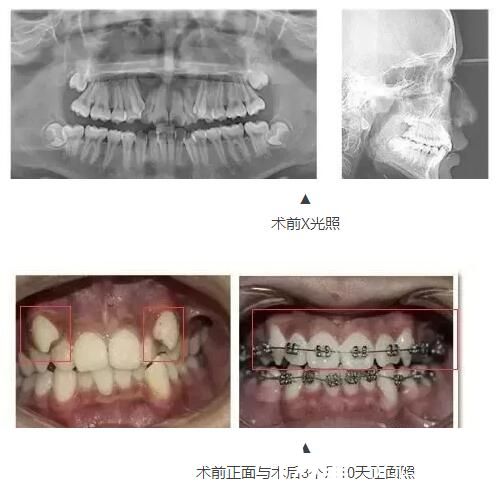 金屬矯正牙齒不整齊 金屬矯正牙齒不整齊
