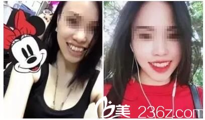 上班族牙齒矯正案例 上班族牙齒矯正案例