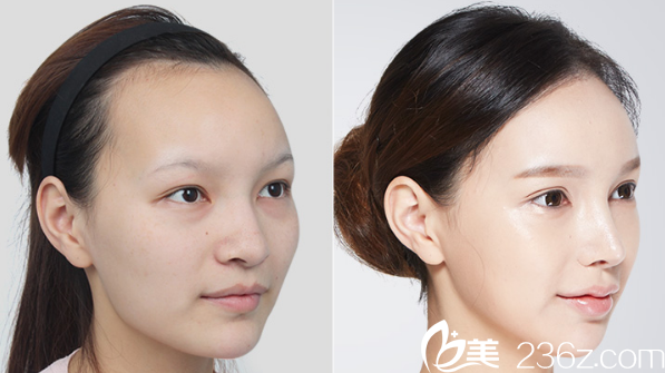 韓國(guó)da面部輪廓整形<span style= 韓國(guó)da面部輪廓整形<span style=