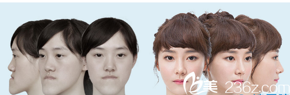 韓國(guó)id整形醫(yī)院V-line下頜角手術(shù)<span style=