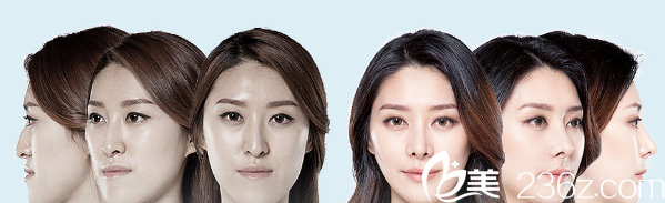 韓國(guó)ID整形醫(yī)院雙鄂整形前后對(duì)比<span style=