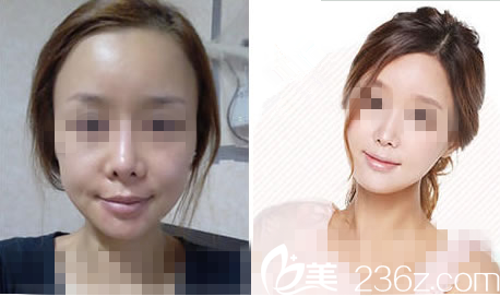 韓國麗妃整形外科真人案例