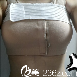 假體隆胸手術(shù)當(dāng)天 假體隆胸手術(shù)當(dāng)天