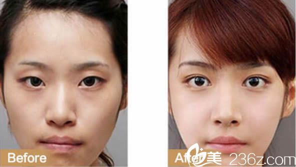 廈門華美賈虹院長雙眼皮案例圖 廈門華美賈虹院長雙眼皮案例圖