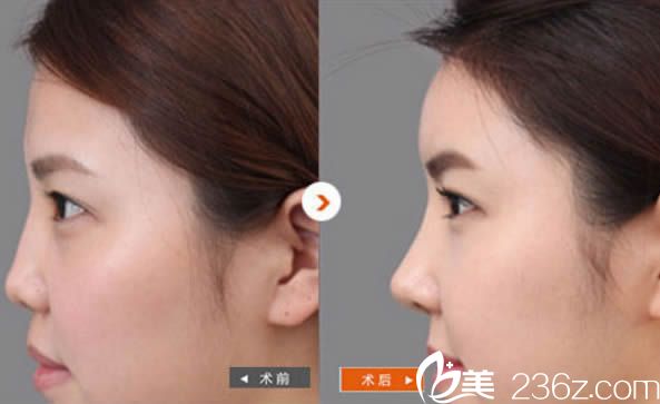 廈門華美醫(yī)院賈虹假體隆鼻對比效果圖 廈門華美醫(yī)院賈虹假體隆鼻對比效果圖