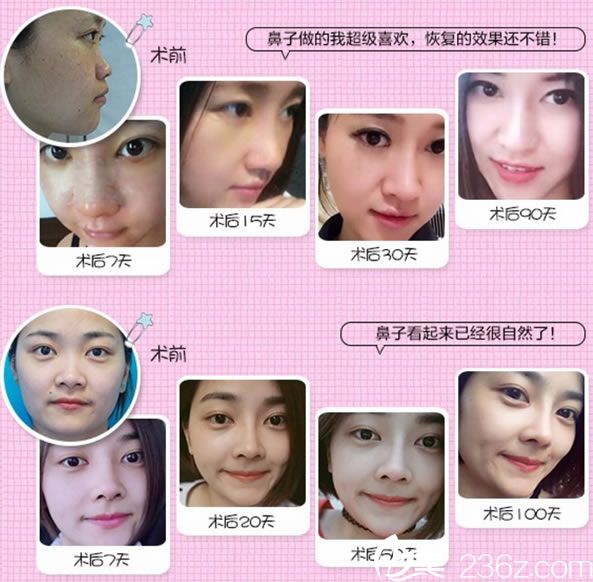 寧波雅韓龔濤鼻綜合整形案例 寧波雅韓龔濤鼻綜合整形案例