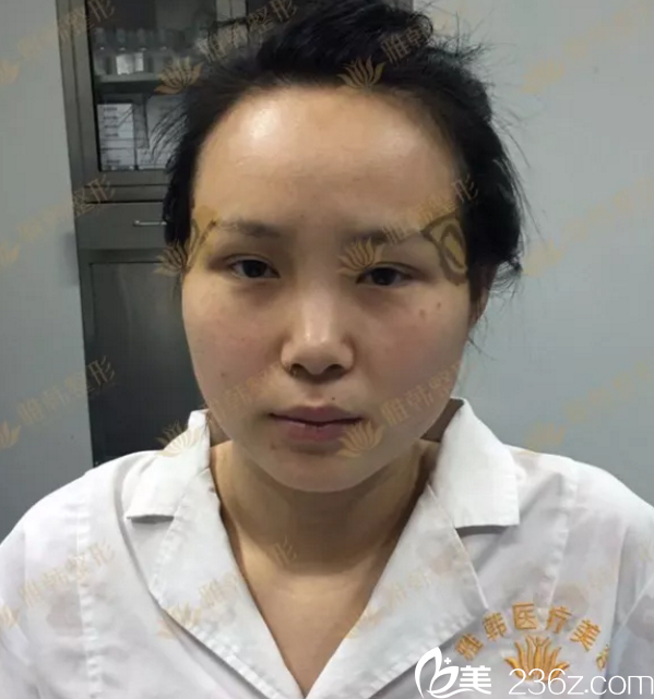 在雅韓做鼻子之前的塌鼻子照片 在雅韓做鼻子之前的塌鼻子照片