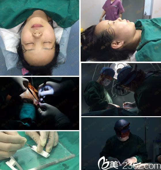 寧波雅韓龔濤耳軟骨鼻綜合手術(shù)過程 寧波雅韓龔濤耳軟骨鼻綜合手術(shù)過程