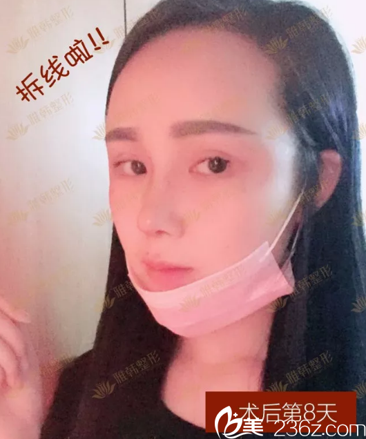 鼻綜合手術(shù)第8天拆線照片 鼻綜合手術(shù)第8天拆線照片