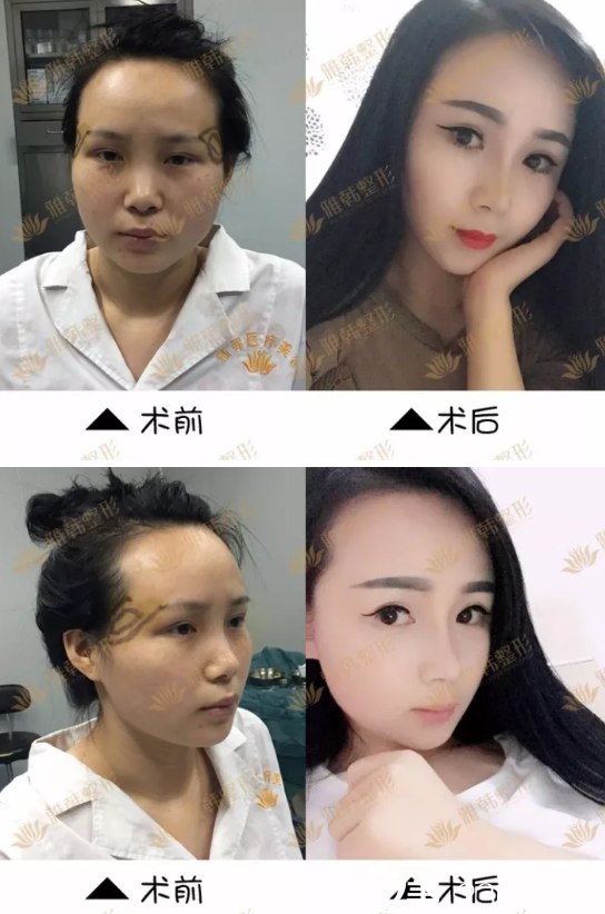 寧波雅韓鼻綜合手術(shù)前后效果對比圖 寧波雅韓鼻綜合手術(shù)前后效果對比圖
