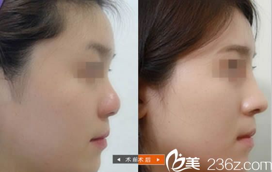 謝常禮做鼻子前后對(duì)比案例 謝常禮做鼻子前后對(duì)比案例