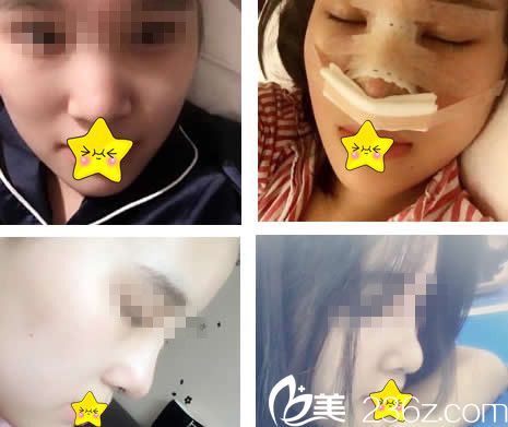 仁和醫(yī)生鼻綜合整形案例 仁和醫(yī)生鼻綜合整形案例