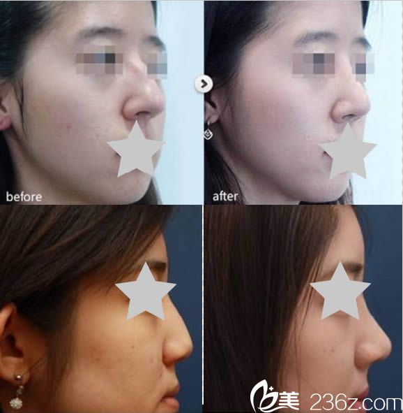 曾高做鼻子的圖片