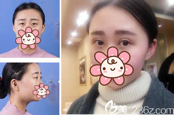 蘭州仁和整形王彥平醫(yī)生全切雙眼皮+開(kāi)眼角三個(gè)月效果案例 蘭州仁和整形王彥平醫(yī)生全切雙眼皮+開(kāi)眼角三個(gè)月效果案例