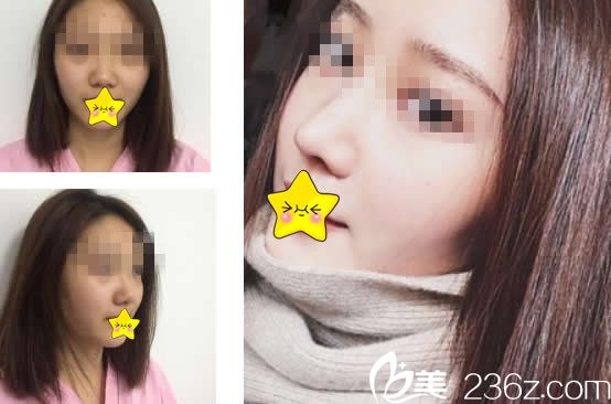 王彥平醫(yī)生隆鼻效果好嗎 王彥平醫(yī)生隆鼻效果好嗎