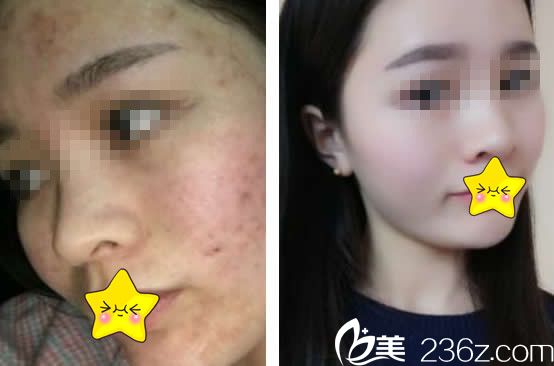 蘭州仁和王彥平點(diǎn)陣激光祛痘效果 蘭州仁和王彥平點(diǎn)陣激光祛痘效果