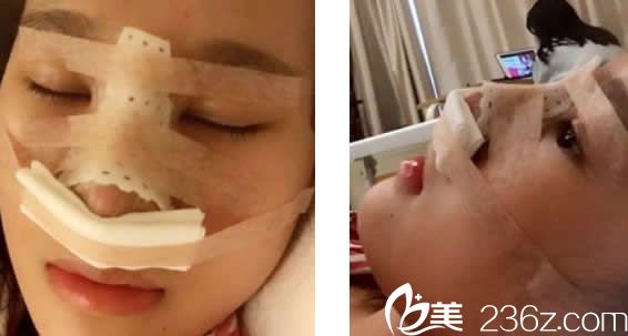 仁和<!--<i data=20240703-sp></i>-->自體肋軟骨隆鼻當(dāng)天