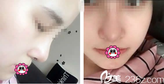 <!--<i data=20240703-sp></i>-->隆鼻案例