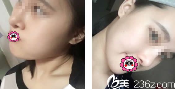 自體軟骨隆鼻13天效果