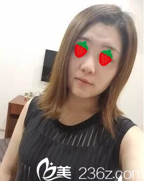 術(shù)前大鼻頭 術(shù)前大鼻頭