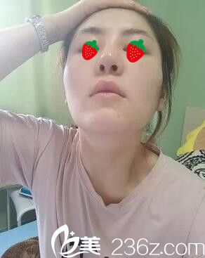 鼻綜合術(shù)后三天恢復(fù) 鼻綜合術(shù)后三天恢復(fù)