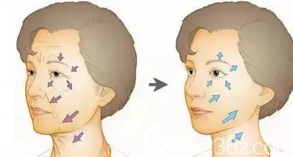 PPDO線(xiàn)雕提拉術(shù)的原理 PPDO線(xiàn)雕提拉術(shù)的原理