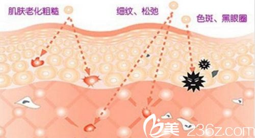 光子嫩膚原理 光子嫩膚原理