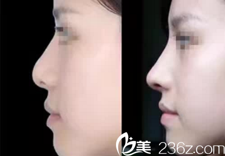 鼻部手術真人案例 鼻部手術真人案例