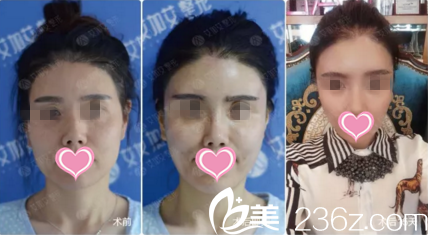 面部脂肪填充前后對(duì)比效果 面部脂肪填充前后對(duì)比效果