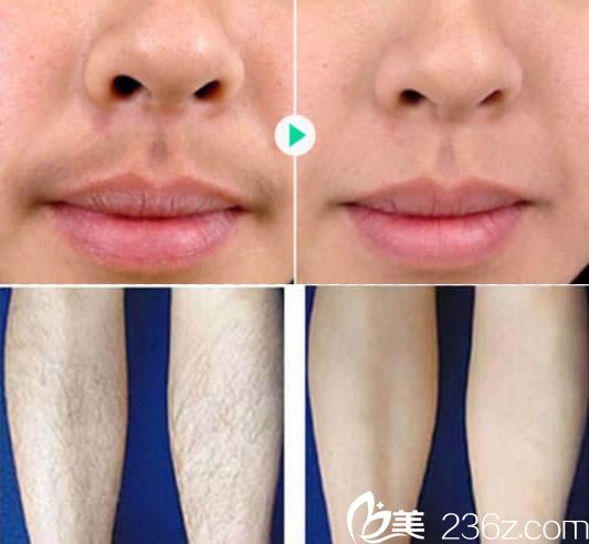 陳秋珍唇部和小腿脫毛案例圖