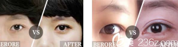 汝森楊子偉雙眼皮效果 汝森楊子偉雙眼皮效果