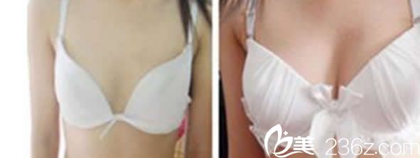 包頭汝森自體脂肪豐胸案例 包頭汝森自體脂肪豐胸案例