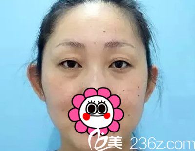 在長(zhǎng)春醫(yī)美做雙眼皮整形前 在長(zhǎng)春醫(yī)美做雙眼皮整形前